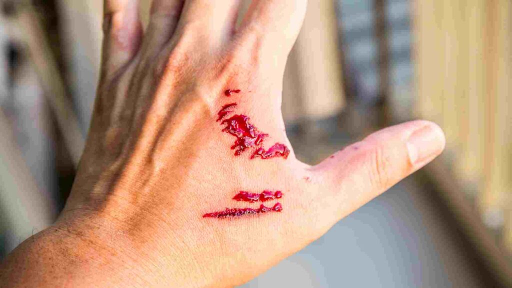 Adverse-Effects-on-Dog-Bite-Victims